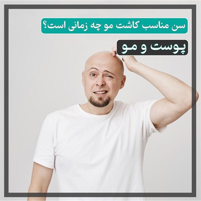  سن مناسب کاشت مو چه زمانی است؟